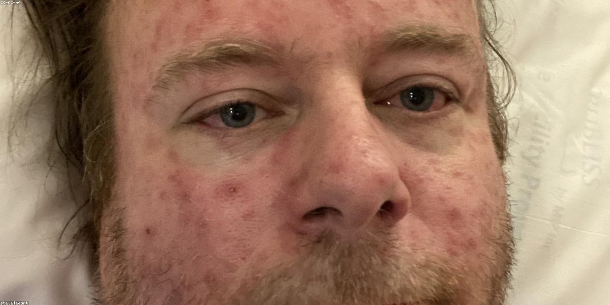 Hồi phục sau tai biến