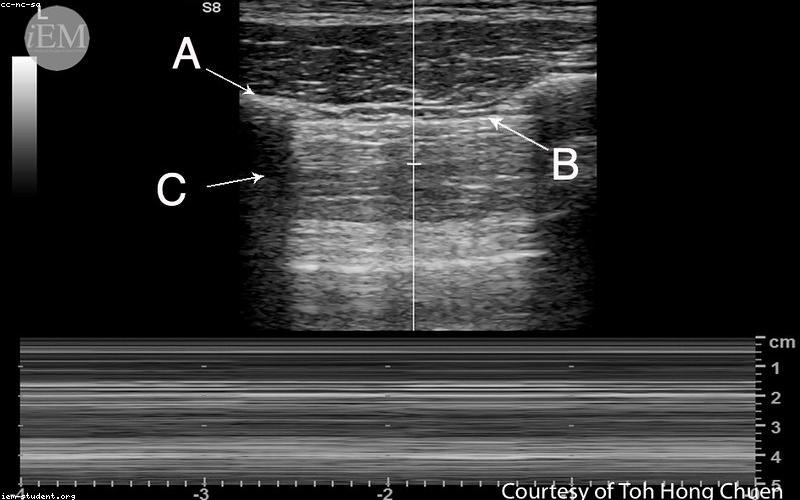 Hình ảnh siêu âm thai nhi
