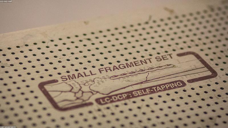 Các loại nẹp chỉnh hình hiện đại