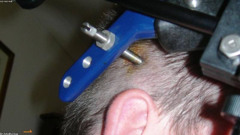 Nẹp cột sống thắt lưng